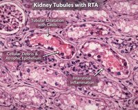Renal Tubules Disorder