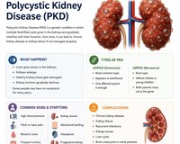 Polycystic Kidney Disease (PKD)
